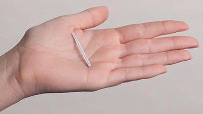 Подкожные противозачаточные имплантаты