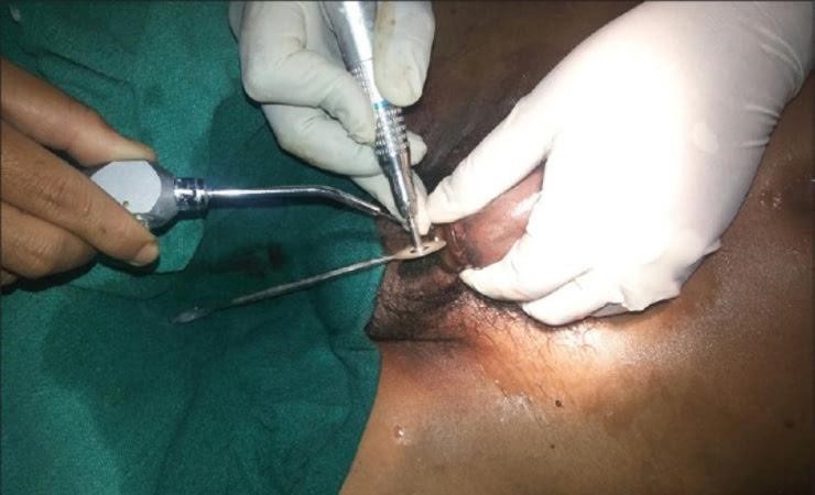 удаление подшипника с члена