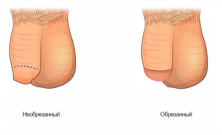 Обрезанный и необрезанный член В чем разница