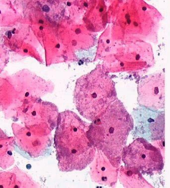 Бактериальный вагиноз или гарднереллез