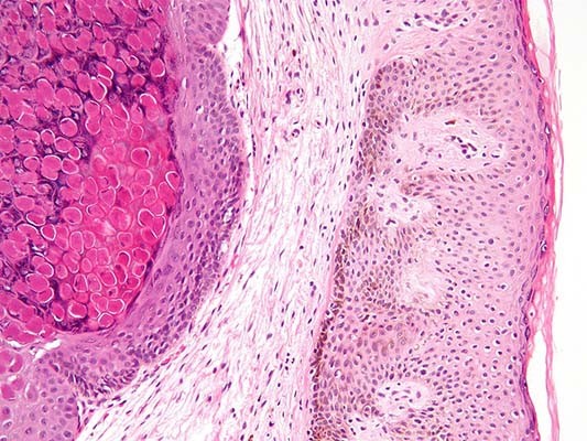 Контагиозный моллюск