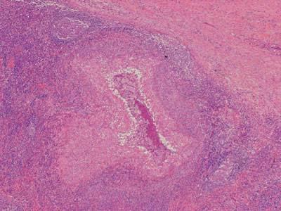 Лимфогранулематоз паховый