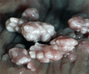 Папилломавирусная инфекция