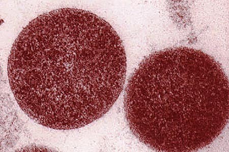 Уреаплазмоз